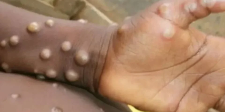 Descartan casos de viruela del mono en Sonora