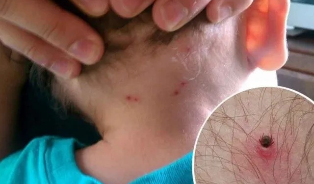 Rickettsia en Sonora: Una amenaza persistente con 118 casos confirmados y 40 defunciones