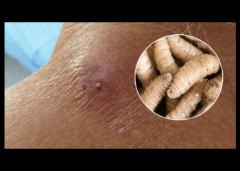 México confirma primer caso humano de miasis por gusano barrenador en una mujer de 77 años