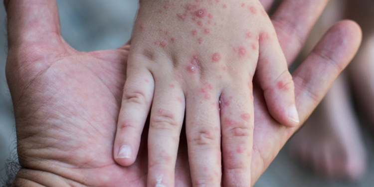 Detectan 12 casos sospechosos de sarampión