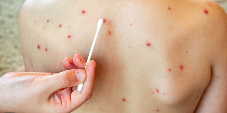 Confirman un caso de sarampión en Sonora