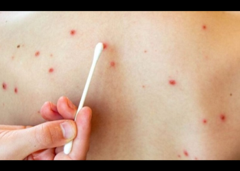 Tiene Sonora 17 casos confirmados de sarampión; fueron importados de Chihauhua