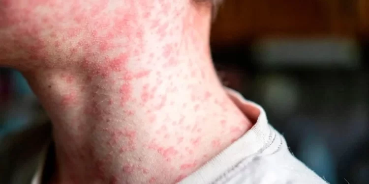 Supera Sonora a Chihuahua en letalidad por sarampión