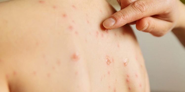 Chihuahua ocupa el primer lugar nacional en sarampión, con dos mil 179 casos; le sigue Sonora, con 69