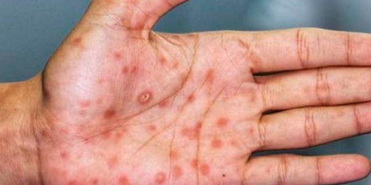 Reportan brote de sarampión entre jornaleros agrícolas en Sonora