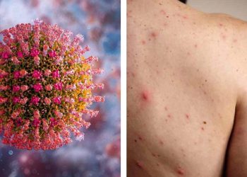 Sarampión avanza con 3 mil 911 casos confirmados; Chihuahua presenta 13 fallecidos, hay uno en Sonora