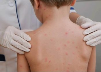 Sube a 14 la cifra de muertes por sarampión en Chihuahua