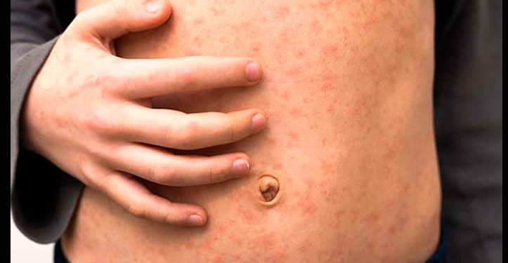 México encabeza muertes por sarampión en América y es segundo en contagios: Informe de la OPS