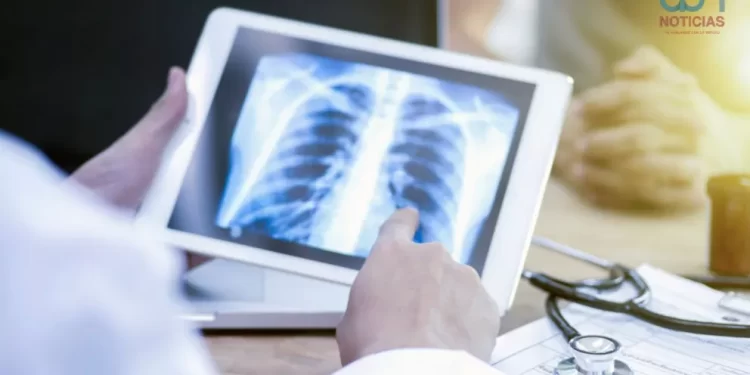 ¡Alerta por tuberculosis! Este es el estado que concentra el 50% de los contagios