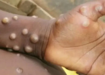 Descartan casos de viruela del mono en Sonora