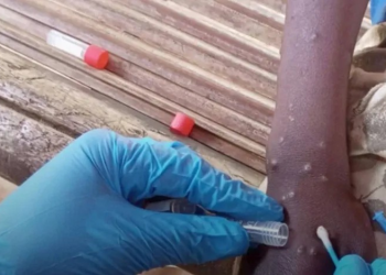 ¿Se Han presentado Casos de Viruela Símica en Sonora? Esto se Sabe