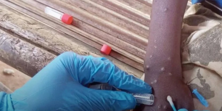 ¿Se Han presentado Casos de Viruela Símica en Sonora? Esto se Sabe