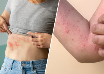 Nuevos casos de Mpox en Sonora y Arizona