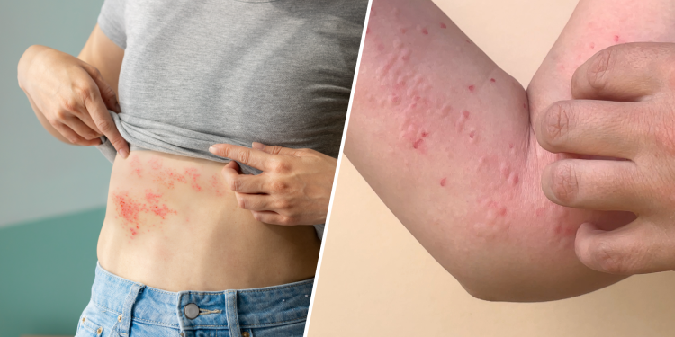 Nuevos casos de Mpox en Sonora y Arizona