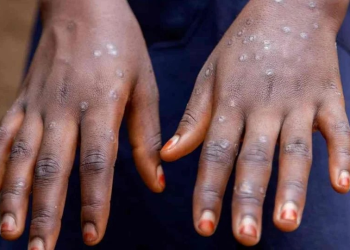 Van 61 casos de mpox en México; registran seis nuevos pacientes en la CDMX, Sonora y Veracruz