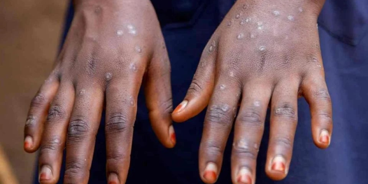 Van 61 casos de mpox en México; registran seis nuevos pacientes en la CDMX, Sonora y Veracruz