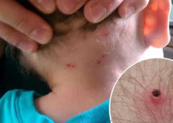 Rickettsia en Sonora: Una amenaza persistente con 118 casos confirmados y 40 defunciones