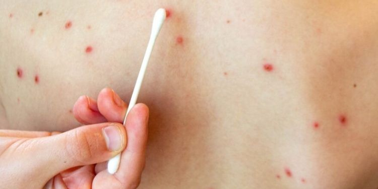 Confirman cuatro nuevos casos de sarampión