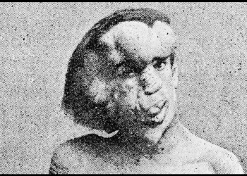 Los placeres ocultos, su trabajo como fenómeno de circo y la atormentada vida del “hombre elefante”: “Soy una persona con alma”