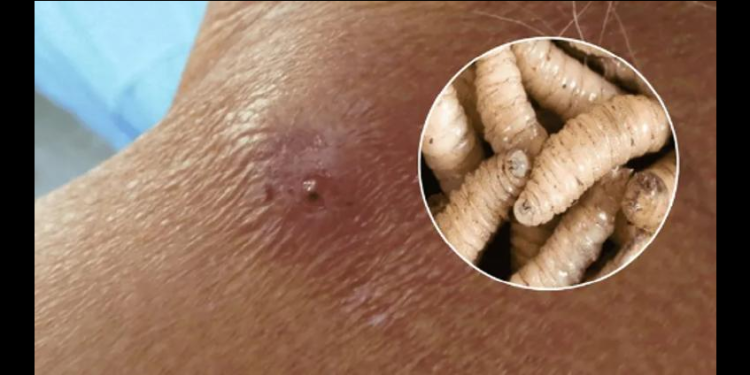 México confirma primer caso humano de miasis por gusano barrenador en una mujer de 77 años