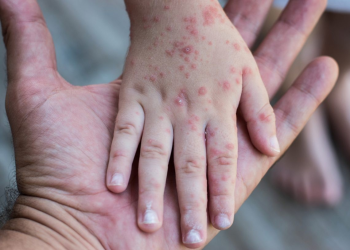 Detectan 12 casos sospechosos de sarampión