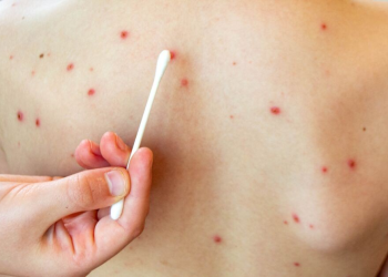 Confirman un caso de sarampión en Sonora