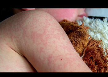 Confirma Secretaría de Salud defunción de una menor de un año por sarampión