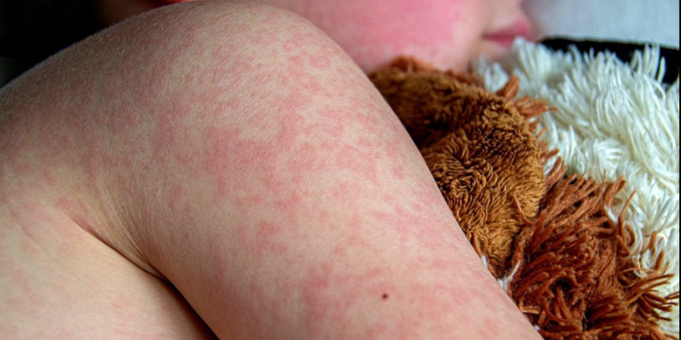 Confirma Secretaría de Salud defunción de una menor de un año por sarampión