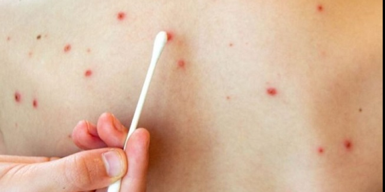 Tiene Sonora 17 casos confirmados de sarampión; fueron importados de Chihauhua