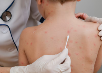 Sarampión en México: la enfermedad afecta a 17 estados y ya se reportan 4 muertes