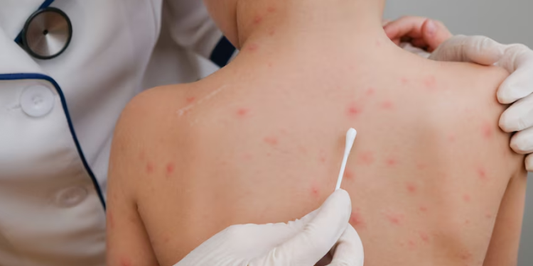 Sarampión en México: la enfermedad afecta a 17 estados y ya se reportan 4 muertes