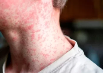 Supera Sonora a Chihuahua en letalidad por sarampión