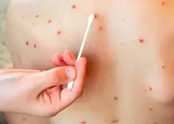 Chihuahua, el estado con más casos de sarampión en el continente americano