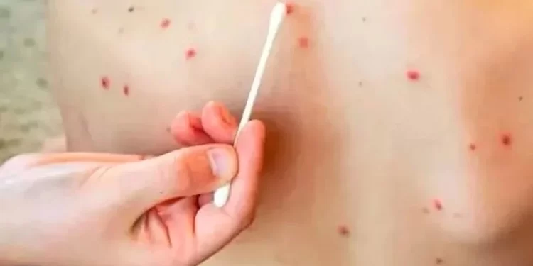 Chihuahua, el estado con más casos de sarampión en el continente americano