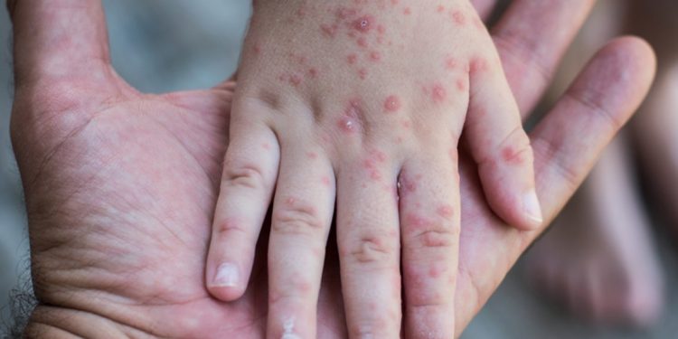 Sonora continúa sumando casos de sarampión