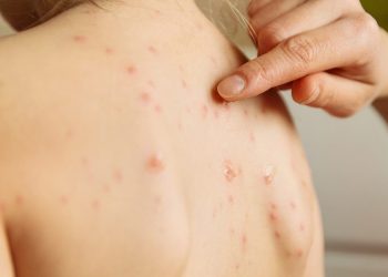 Chihuahua ocupa el primer lugar nacional en sarampión, con dos mil 179 casos; le sigue Sonora, con 69