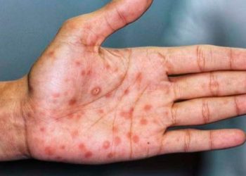 Reportan brote de sarampión entre jornaleros agrícolas en Sonora