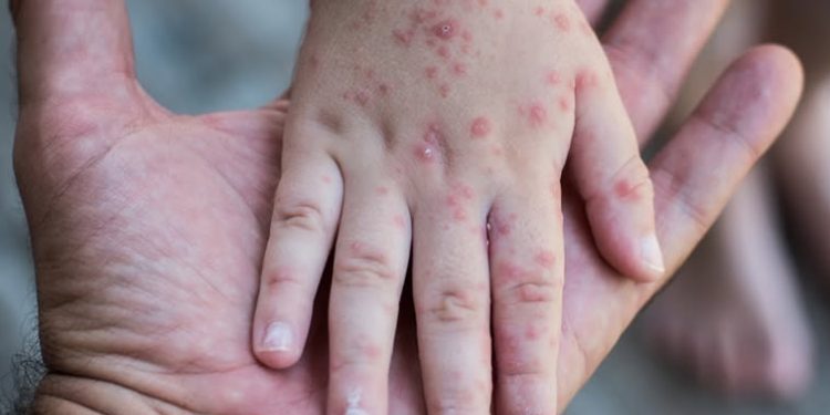 Con 86 casos confirmados Sonora ocupa segundo lugar en contagios de sarampión