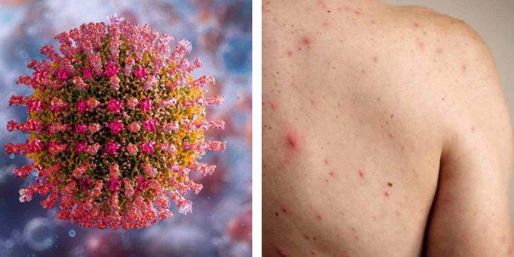 Sarampión avanza con 3 mil 911 casos confirmados; Chihuahua presenta 13 fallecidos, hay uno en Sonora