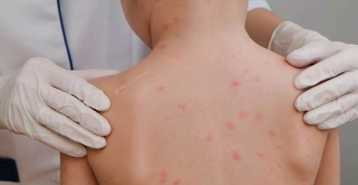 Sube a 14 la cifra de muertes por sarampión en Chihuahua