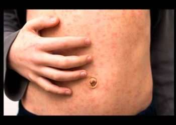 México encabeza muertes por sarampión en América y es segundo en contagios: Informe de la OPS