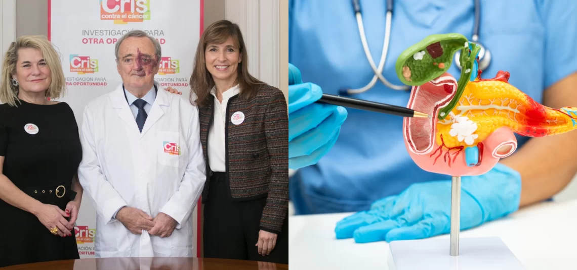 Investigadores españoles logran erradicar el cáncer de páncreas en modelos animales