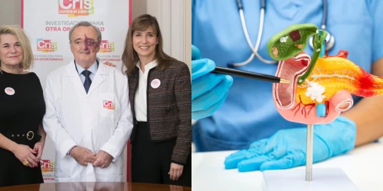 Investigadores españoles logran erradicar el cáncer de páncreas en modelos animales