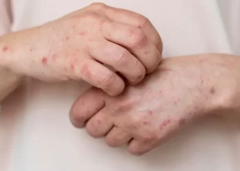 “Es la crónica de una epidemia anunciada”: tres expertos hablan sobre las claves del brote de sarampión en México