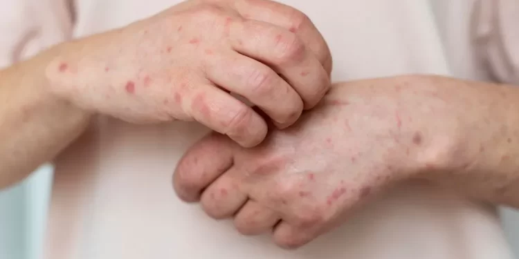 “Es la crónica de una epidemia anunciada”: tres expertos hablan sobre las claves del brote de sarampión en México