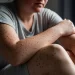 Hermosillo lidera en casos de Fiebre Manchada por Rickettsia en Sonora 2026
