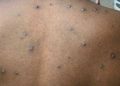Arizona confirma aumento de casos de una cepa más letal de mpox