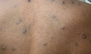 Arizona confirma aumento de casos de una cepa más letal de mpox