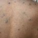 Arizona confirma aumento de casos de una cepa más letal de mpox